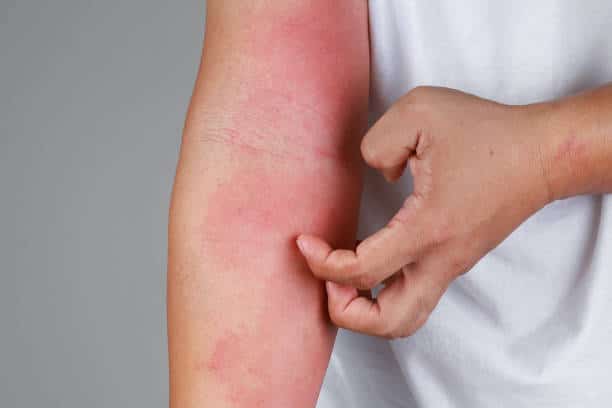 allergy 22112401
